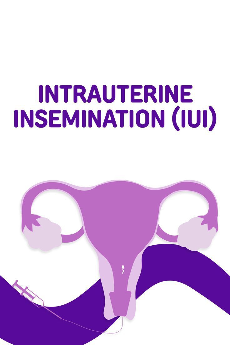 IUI